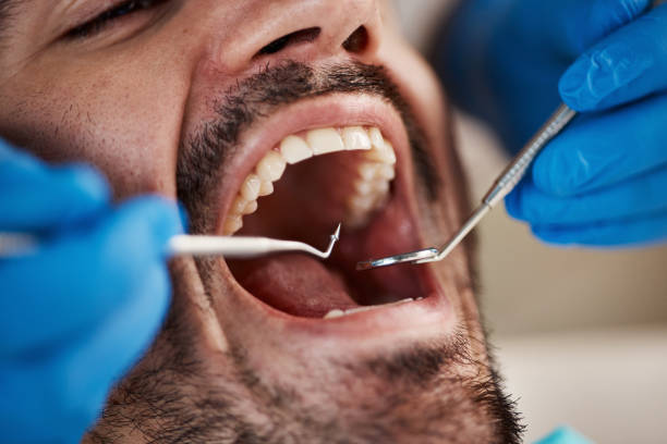 Best Emergency Tooth Extraction in Humboldt Hill, CA